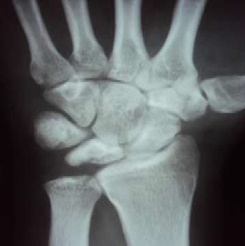 The plain x-ray AP view of right hand that showed sclerotic changes of the lunate bone [