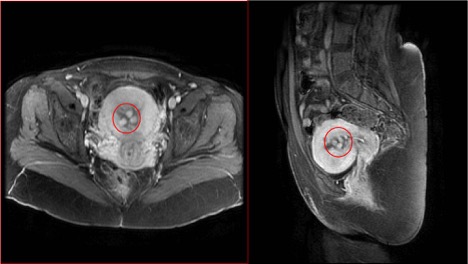 Figure 1: Axial and sagittal pelvic magnetic resonance imaging with gadolinium demonstrating multiple variable-sized hypervascular endometrial polyps