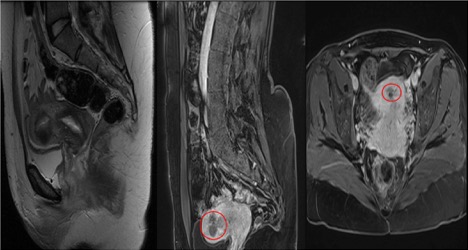 Figure 3: Enhanced pelvic magnetic resonance imaging after 7 and 18 months of uterine artery embolization showing complete avascular atrophy of endometrial polyps