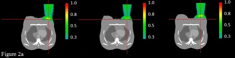Axial views of 6 MeV Dose distribution normalized to the maximum dose, evaluated through GATE for the breast tumor bed case,  left, middle and right slices represent the central slice of the beam in a small breast size, medium  size and large breast size respectively, cross hair stand for the tumor bed central point.