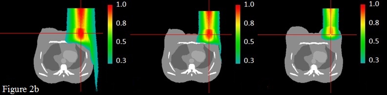 Axial views of 12 MeV Dose distribution normalized to the maximum dose, evaluated through GATE for the breast tumor bed case, the left, middle and right slices represent the central slice of the beam in a small breast size, medium  size and large breast size respectively, cross hair stand for the tumor bed central point.