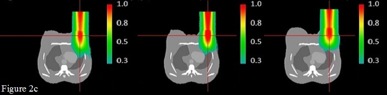 Axial views of 18 MeV Dose distribution normalized to the maximum dose, evaluated through GATE for the breast tumor bed case, the left, middle and right slices represent the central slice of the beam in a small breast size, medium  size and large breast size respectively, cross hair stand for the tumor bed central point.